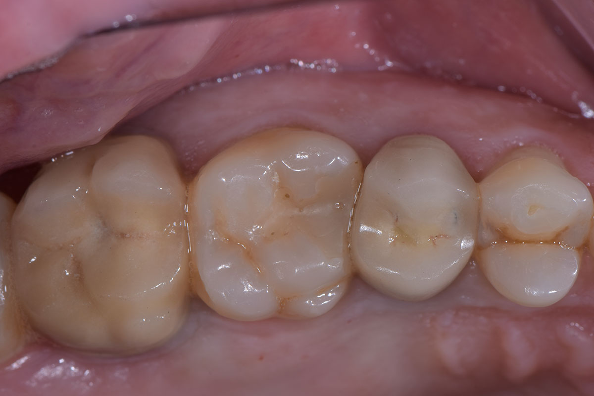 Chiara prima del trattamento odontoiatrico di estetica e protesi