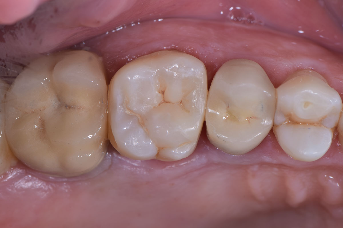 Chiara dopo il trattamento odontoiatrico di estetica e protesi