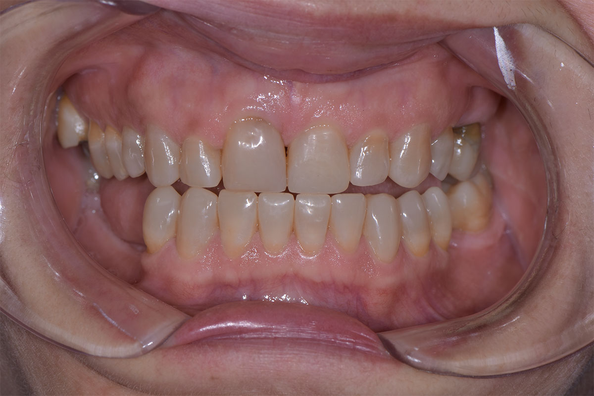 Marcella dopo il trattamento di odontoiatria estetica
