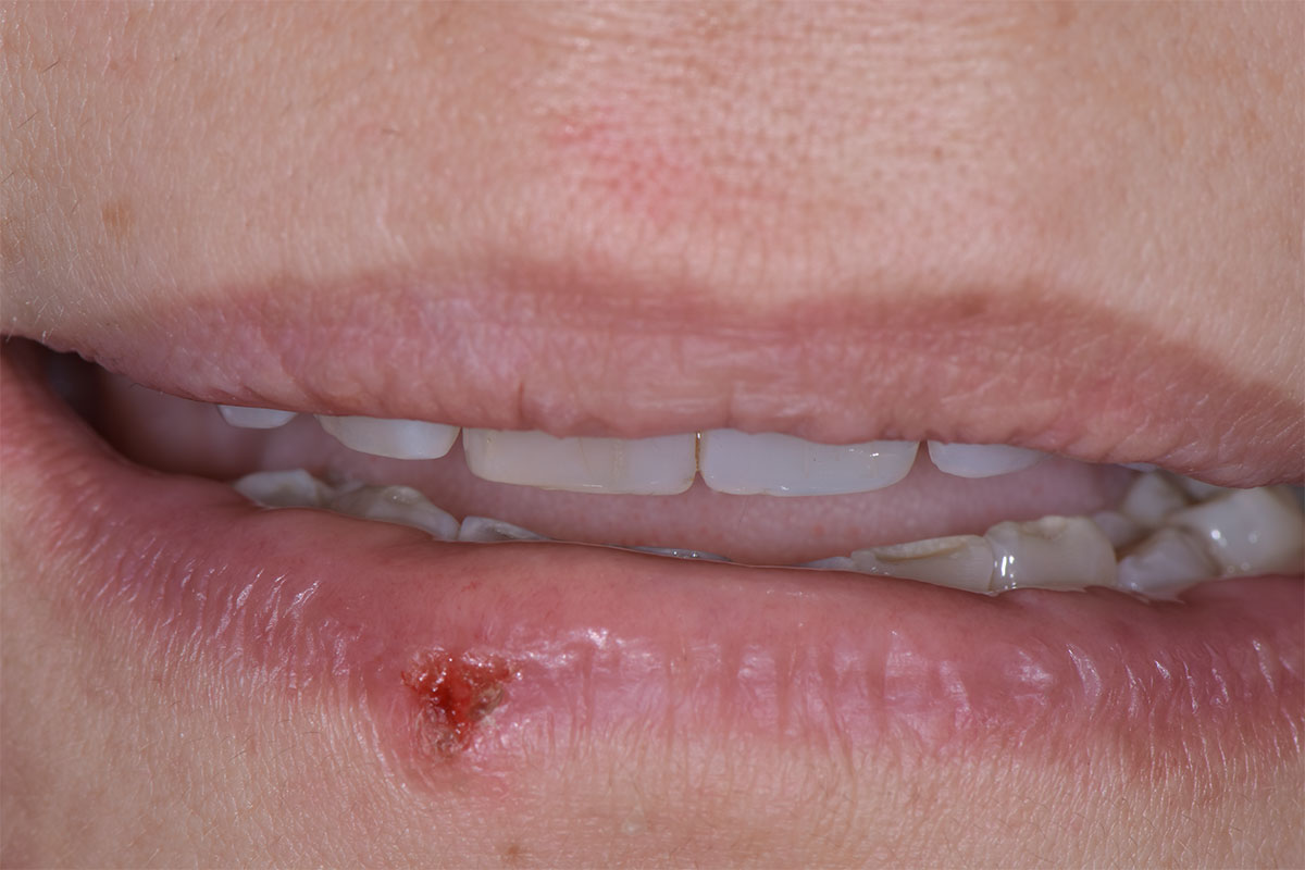 Marcella prima del trattamento di odontoiatria estetica