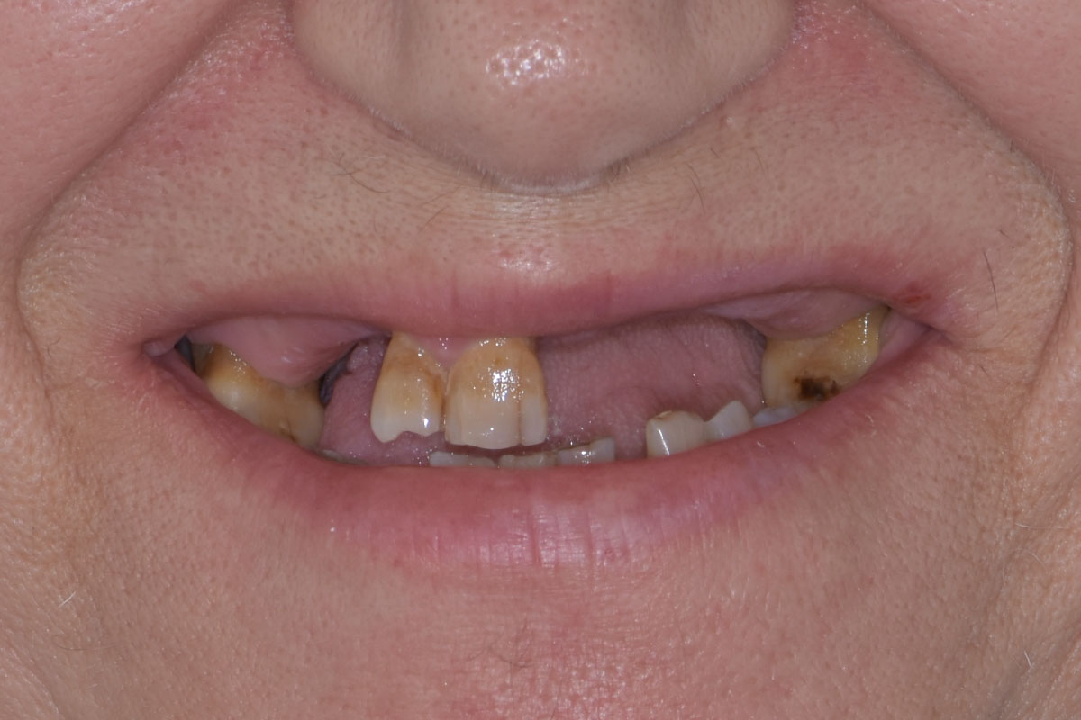 Maria prima del trattamento odontoiatrico risolutivo